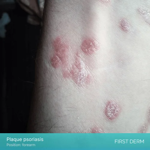 A close-up photo of a person’s forehand with red, scaly patches of skin that are typical of plaque psoriasis, a chronic inflammatory skin condition