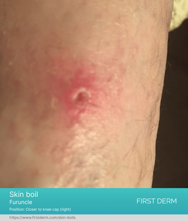 Stage of skin boil healing process: picture of boil after pus drainage, revealing redness and swelling in the surrounding skin tissue