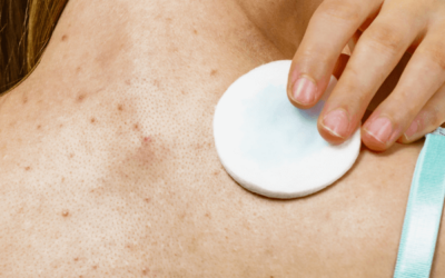 Do Supplements Help with Acne?  What Science Really Says